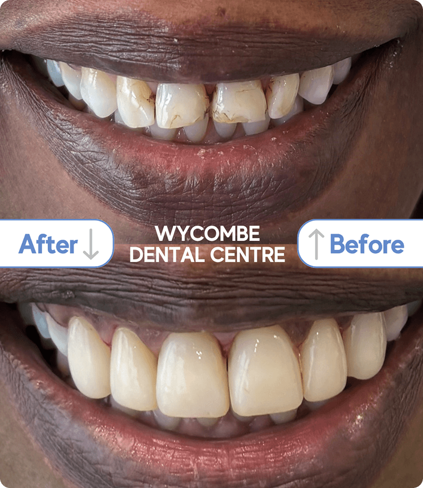 Patient discussing the benefits of composite bonding treatment