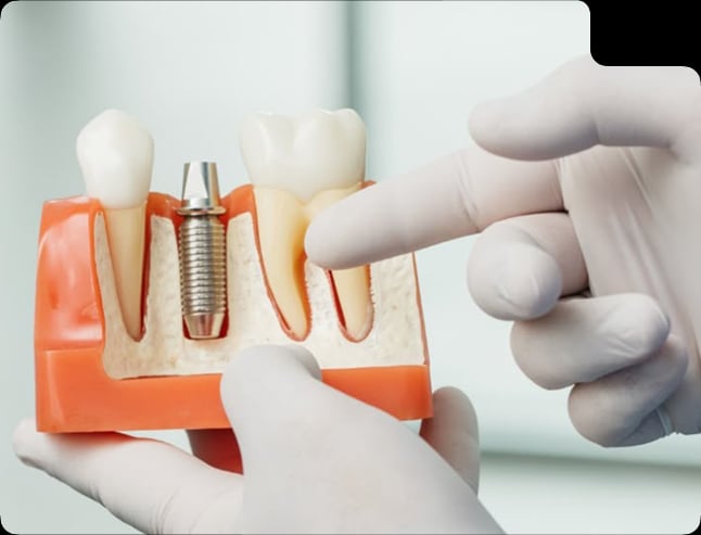 Dental implant model showing how an implant supports a replacement tooth